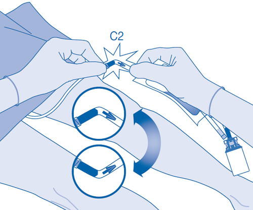 Due mani che tengono un dispositivo medico con connettori circolari e frecce che indicano la rotazione