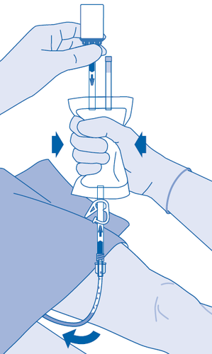Mani con guanti che preparano e inseriscono un dispositivo di infusione sottocutanea con freccia curva indicante la direzione