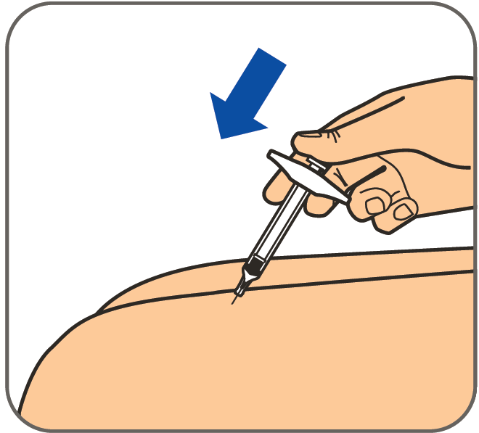 Mano che inserisce un ago di siringa nella pelle, freccia blu indica la direzione dell