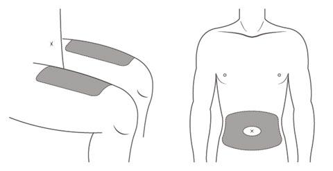 Schizzo di torso umano con indicazione di applicazione di cerotti rettangolari grigi su fianco e addome