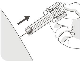 Siringa pre-riempita con ago inserito ad angolo nella cute, freccia nera indica direzione di iniezione, mano che tiene lo strumento