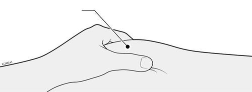 Iniezione sottocutanea nel braccio con ago inserito ad angolo piatto rispetto alla pelle