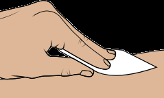 Iniezione sottocutanea eseguita con ago corto e smussato inclinato sulla plica cutanea della coscia