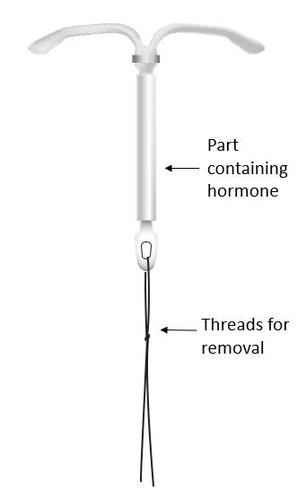 Dispositivo intrauterino a forma di T con fili sottili neri all