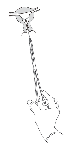 Mano che stringe una pinza chirurgica che afferra un dispositivo a forma di spirale inserito in un canale anatomico