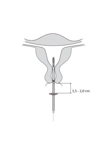 Utero schematizzato con ago inserito e indicazione di profondit&agrave; di iniezione da 1,5 a 2,0 cm