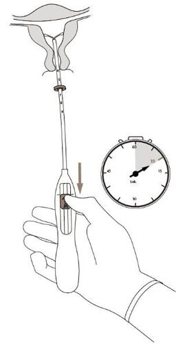 Dispositivo intrauterino con applicatore e maniglia impugnata da una mano vicino a un orologio che indica le 10