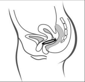 Apparecchio intrauterino a forma di spirale inserito nell
