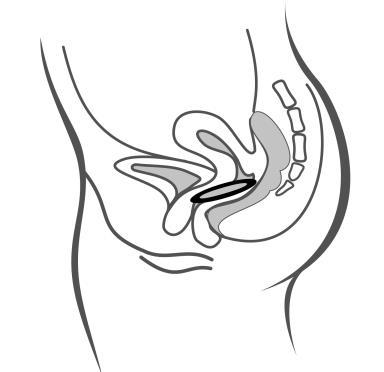 Apparezione schematica del tratto genitale femminile con utero, ovaie, tube e vagina evidenziate in diverse tonalit&agrave; di grigio