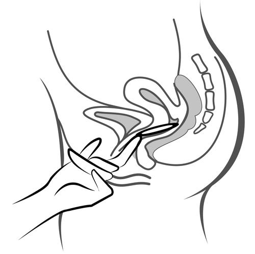 Mano che inserisce un applicatore intravaginale nell