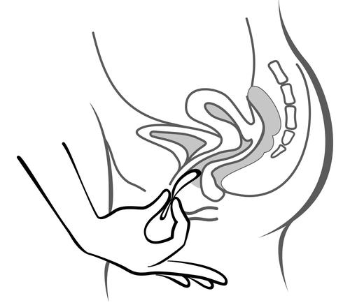 Mano che inserisce un applicatore intravaginale con forma anatomica nell