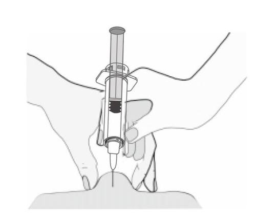 Mano che tiene una siringa pre-riempita con ago inserito nella pelle, tecnica di iniezione sottocutanea illustrata in bianco e nero