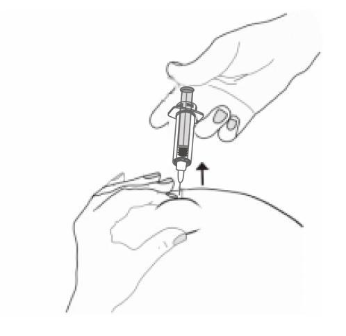 Mano che stringe la pelle e inietta farmaco sottocutaneo con siringa, ago inserito e freccia che indica la direzione