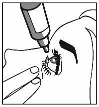 Mano che tiene un flacone contagocce che rilascia gocce negli occhi aperti di una persona