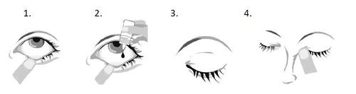 Occhio che riceve gocce da un flacone, fasi successive di inclinazione della testa e applicazione del farmaco