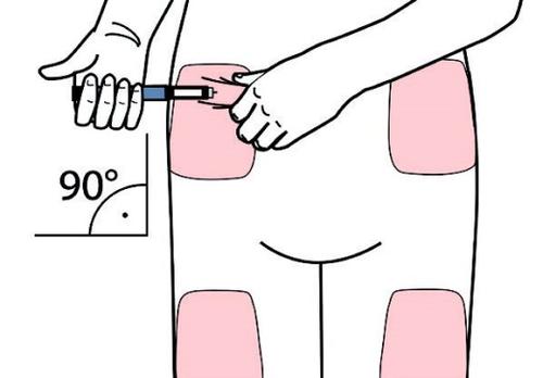 Mano che inietta farmaco con siringa in zona addominale, indicazione angolo di 90 gradi e aree di iniezione evidenziate in rosa