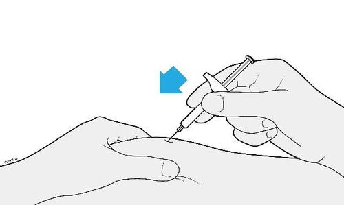 Mano che tiene una siringa con ago che penetra nella pelle del braccio, freccia blu indica il punto di iniezione sottocutanea