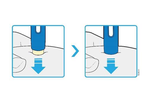 Dispositivo blu premuto sulla pelle con freccia verso il basso che indica la pressione per l