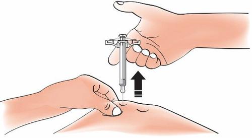 Mano che tiene una siringa preraempita con ago inserito nella pelle, freccia nera indica direzione di iniezione