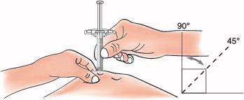 Mano che tiene una siringa con ago inserito nella pelle a 90 gradi e indicazione di angolo di 45 gradi con freccia