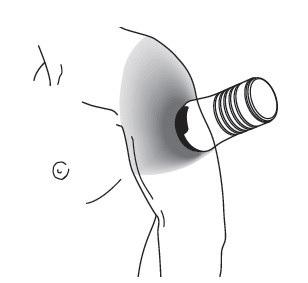 Iniettore penna con ago inserito nel tessuto sottocutaneo della coscia, tecnica di iniezione illustrata