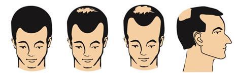 Progressione della calvizie maschile mostrata su profili di teste con perdita di capelli crescente