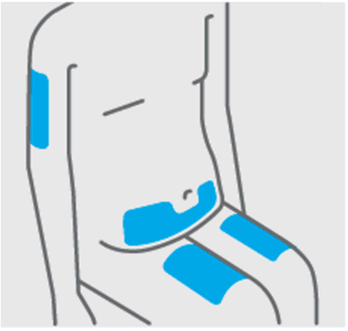 Schizzo di ginocchio con evidenziate in blu le aree di iniezione intra-articolare e periarticolare laterale e mediale