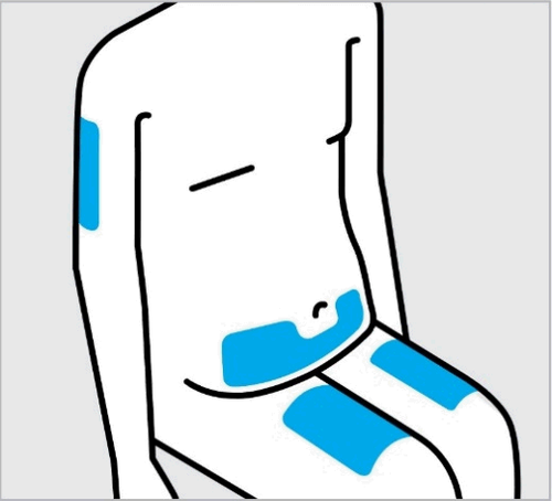 Schizzo di schiena e fianco umano con aree blu che indicano possibili siti di iniezione sottocutanea o intramuscolare