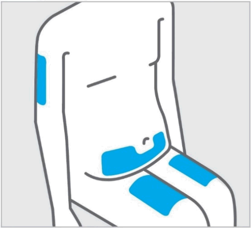 Schizzo di una schiena con evidenziate in blu le aree di applicazione di cerotti o medicazioni adesive