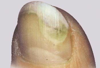 Unghia del piede con decolorazione verde-giallastra e segni di possibile infezione fungina o trauma
