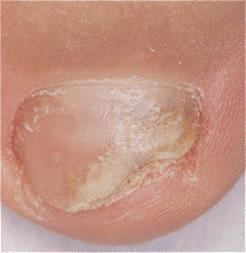 Unghia del piede danneggiata con distacco parziale e presenza di tessuto biancastro e irregolare sottostante