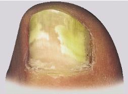 Unghia del piede con alterazione del colore che varia dal giallo al bianco, possibile segno di onicomicosi