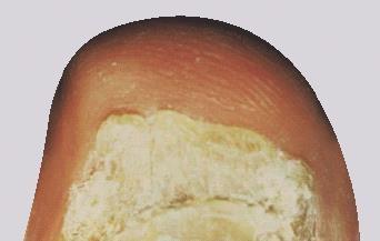 Unghia del piede con distacco dal letto ungueale e presenza di materiale biancastro e friabile sottostante