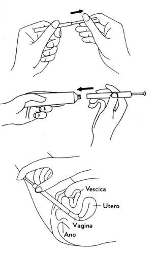 Due mani che tengono un tampone e una penna a forma di cilindro con punta inserita nella vagina vicino a vescica, utero e ano