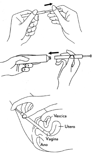 Due mani che tengono una siringa prontasomministrazione, vescica, utero, vagina e ano indicati in un disegno anatomico del bacino femminile