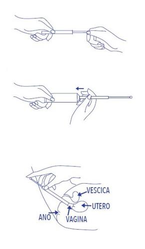 Due mani che inseriscono un tampone vaginale con applicatore, frecce indicano direzione verso vagina, vescica, utero e ano
