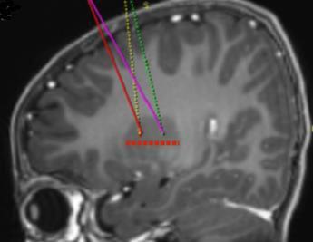 Sezione sagittale di risonanza magnetica cerebrale con linee colorate che indicano aree specifiche e un tracciato punteggiato rosso