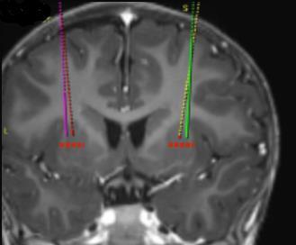 Sezione coronale di risonanza magnetica cerebrale con due elettrodi colorati, rosa e verde, inseriti nel tessuto cerebrale profondo