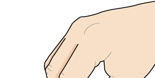 Braccio piegato che mostra il sito di iniezione sottocutanea con due linee verticali parallele indicate sulla pelle