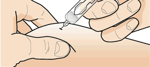 Mano che tiene una siringa con ago inserito nella pelle, tecnica di iniezione sottocutanea con angolo di circa 45 gradi