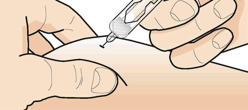Mano che tiene una siringa con ago inserito nella pelle del braccio, tecnica di iniezione sottocutanea illustrata con dettaglio dell