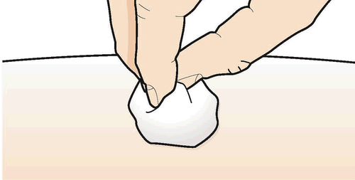 Mano che solleva un lembo di pelle con un batuffolo di cotone bianco su una superficie cutanea beige chiara