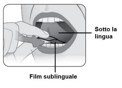 Bocca aperta con una compressa film sublinguale posizionata sotto la lingua e una mano che la aiuta a posizionarsi