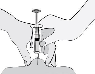 Mano che afferra una siringa con ago inserito nella pelle, tecnica di iniezione sottocutanea con l
