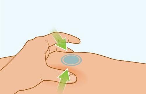 Mano che applica un cerotto adesivo bluastro sulla pelle arrossata con frecce verdi che indicano la direzione di applicazione