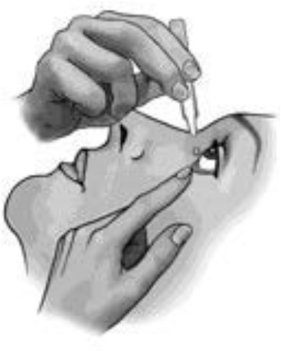 Mano che inserisce una goccia oculare nell