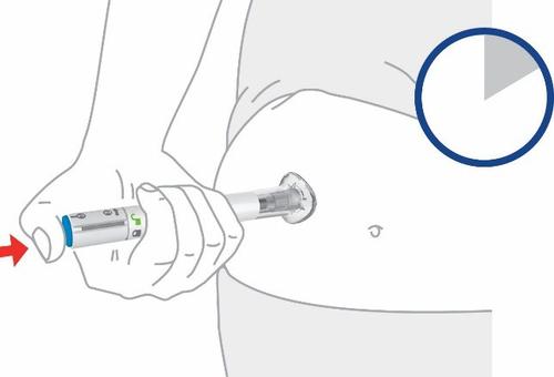 Mano che tiene una siringa preriempita con ago inserito nella cute addominale freccia rossa indica la direzione dell