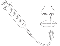 Siringa con ago che somministra farmaco attraverso un catetere inserito nella narice e posizionato vicino alla gola
