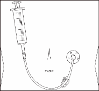 Siringa con ago collegato tramite tubo flessibile ad un dispositivo di infusione cutanea con cerotto adesivo