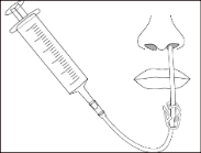 Siringa collegata a un catetere nasale con punta inserita nella narice e fissata con un dispositivo di supporto
